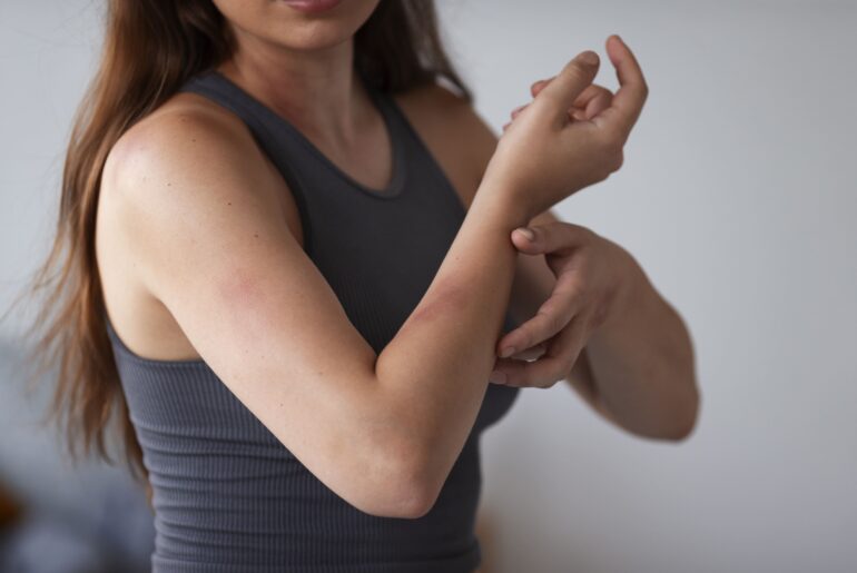 sintomas-da-chikungunya-mulher-cocando-os-bracos-que-estao-com-manchas-vermelhas